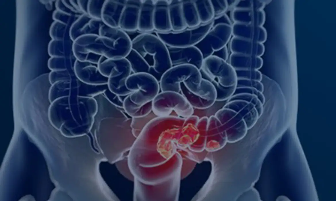 SUS prepara implementação de rastreamento para câncer colorretal - Imagem do artigo original