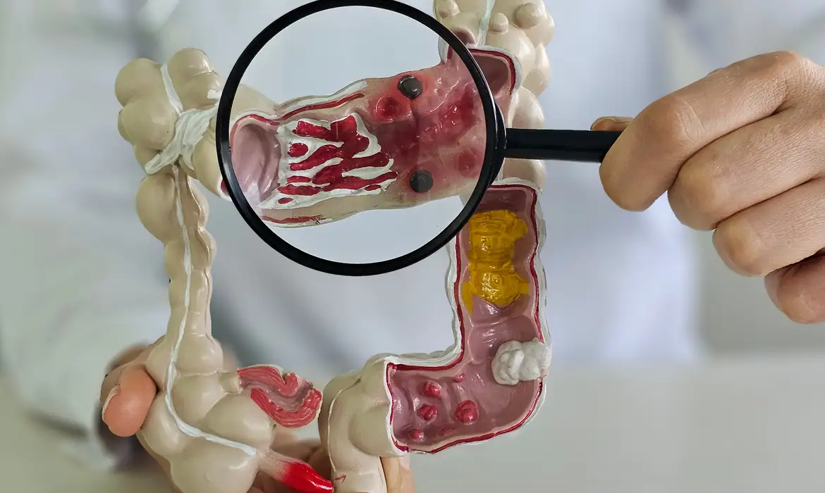 Doença Inflamatória Intestinal: Crescimento Alarmante no Brasil - Imagem do artigo original