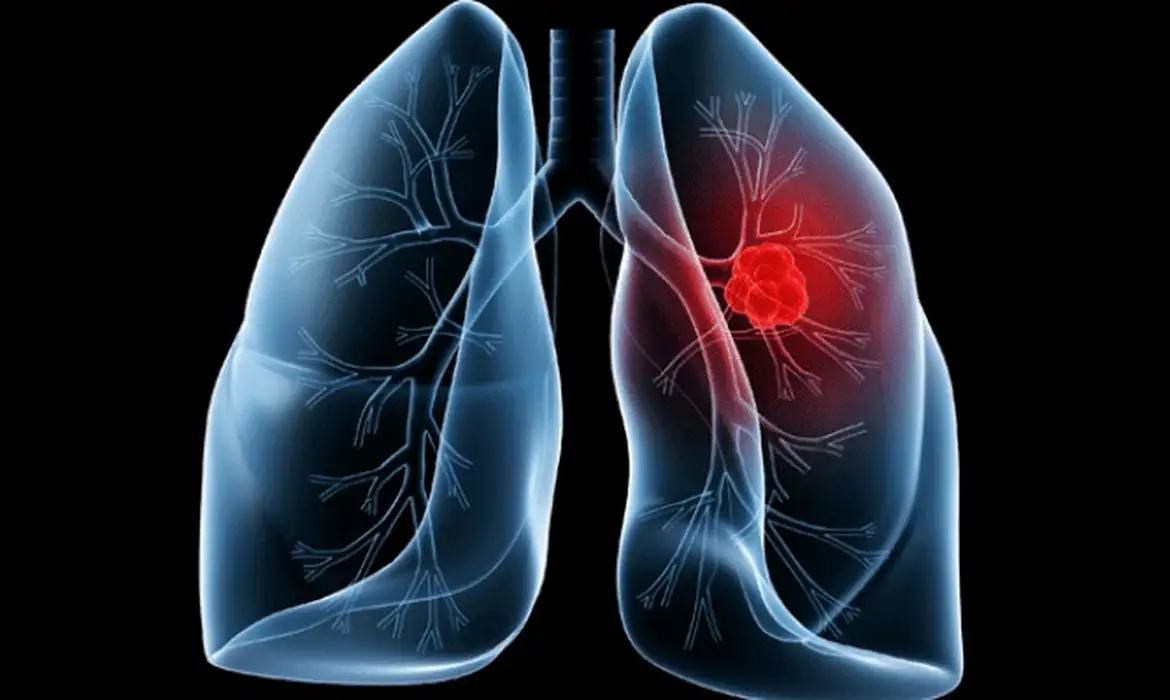 Adenocarcinoma Pulmonar: Entenda o Câncer do Papa Leão XIV - Imagem do artigo original